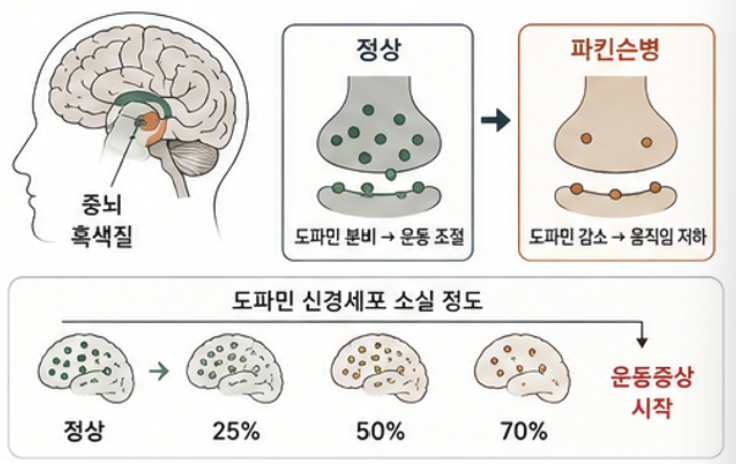 도파민 신경세포 감소와 관련된 파킨슨병 발생 과정