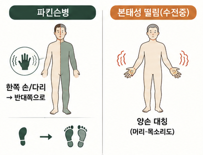 가만히 있을 때 나타나는 파킨슨병 안정 시 떨림